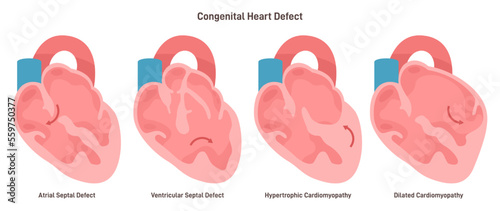 Congenital diseases of the heart set. Ventricular and atrial septal defect,
