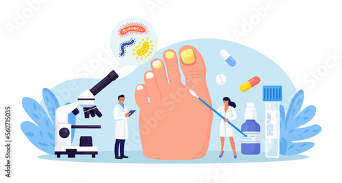 Onychomycosis. Feet with nail disease. Fungal nails infection. Doctors exam, treat nails psoriasis. Doctor dermatologist analyzes psoriatic toenails. Inflammation of toenail skin. Medical treatment