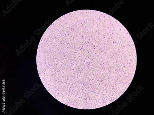 Leukemia blood picture show immature cells mixed stage.