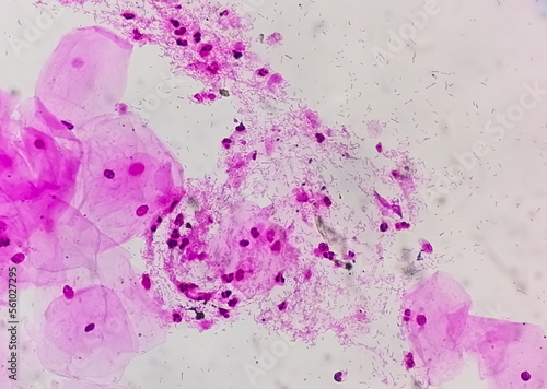 Photomicrograph of gram stain showing Bacterial Vaginosis