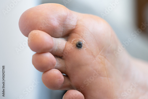 Closeup of dead skin around wart plantar after cauterizing it with celandine on infected foot. Hygiene, human skin disease, papillomavirus or HPV concept. Self-medication. 