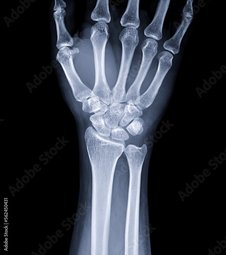 X-ray image of wrist joint for diagnosis rheumatoid arthritis .