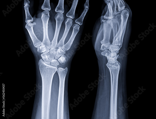 X-ray image of wrist joint for diagnosis rheumatoid arthritis .