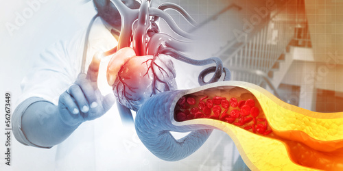 Doctor check and diagnose the heart health, coronary artery disease, cholesterol plaque in artery. 3d illustration