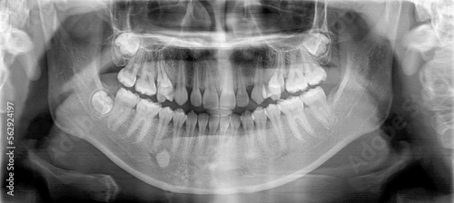 Film panoramic radiography view of the jaw.Multiple embedded and impaction teeth at both maxilla and mandible area.Panoramic dental and mandible x-ray image.