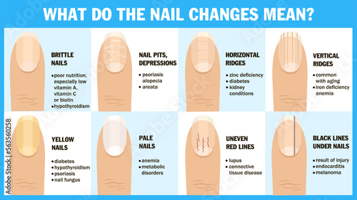 What do the nail changes mean The appearance of the nail and the associated disease. Brittle nails, nail pits, depression, horizontal, vertical ridge. Medical infographic design. Vector illustration
