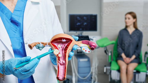 Uterine fibroid, myoma. Gynecologist pointing uterine leiomyomas on anatomical model of uterus while female patient's gynecological consultation