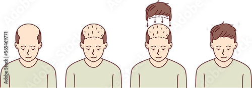 Stages of man hair transplant