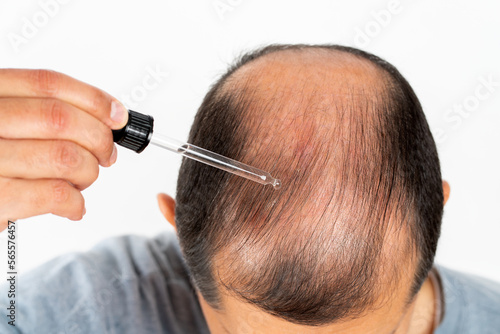 Young man hair treatment. Argan oil healthy massage.Close up of male person who applies a product to stop hair loss. Liquid cosmetic dropper therapy.