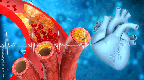 Clogged arteries, coronary artery plaque with human heart. 3d illustration.