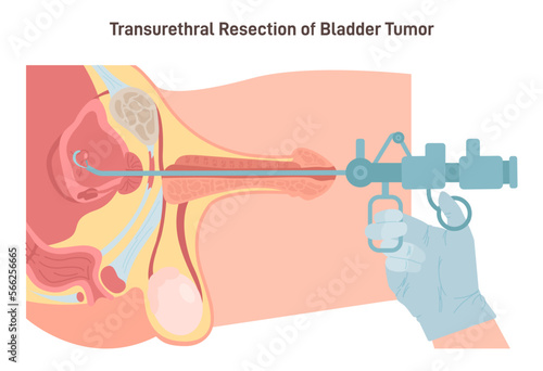 Transurethral resection of the bladder tumor. Male bladder benign