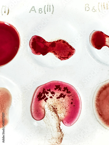 Medical agglutination reaction to determine blood group compatibility