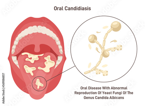 Oral candidiasis. Oral yeast infection of fungal candida albicans