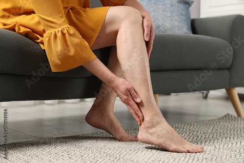 Barefoot woman with varicose veins on sofa in room, closeup