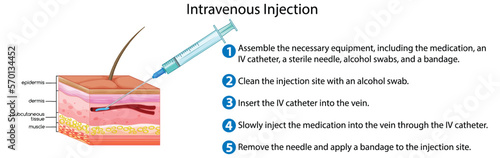 Intravenous Injection with explanation