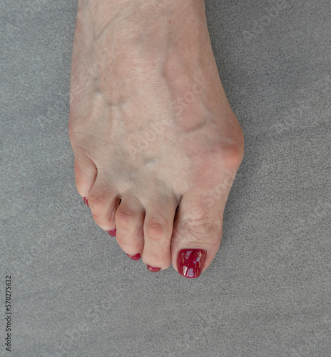 White female foot with bunion or hallux valgus.