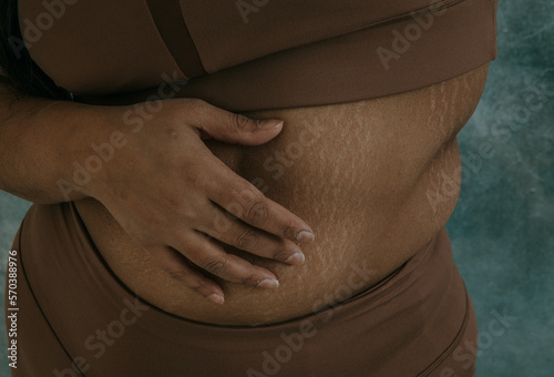 close up of East Indian hand on tummy with stretchmarks