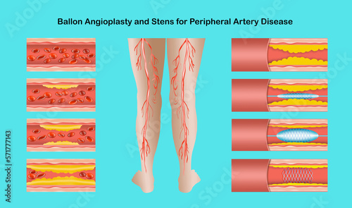 Diagram showing angioplasty for peripheral artery disease illustration. Concept of dry skin, old senior people, varicose veins and DVT .