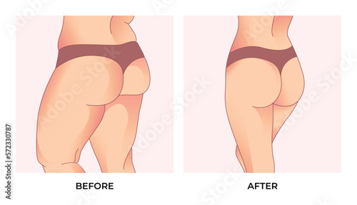 Thigh fat. Before and after weight loss, woman body shape transformation, Fat To Fit.