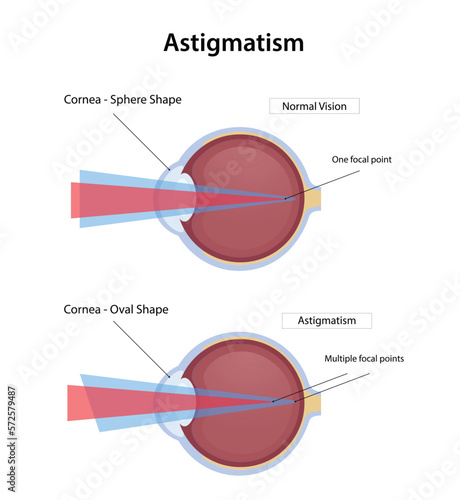 Astigmatism disease, normal vision and astigmatism illustration design