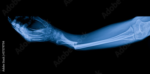 Blue tone radiograph on dark background in hospital.Doctor used xray for diagnosis.Forearm fracture in accident patient.X-ray of child or children in orthopedic surgery unit.