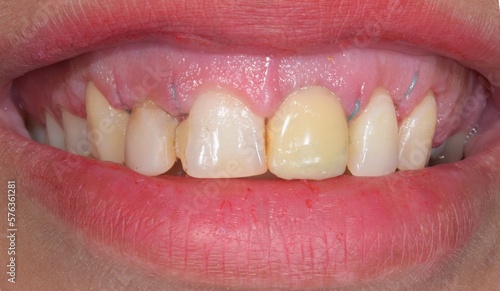 Frontal view of a woman mouth smiling with fake teeth of porcelain fixed prosthetic dental crown in central incisor and gingiva surgery and surgical suture thread.