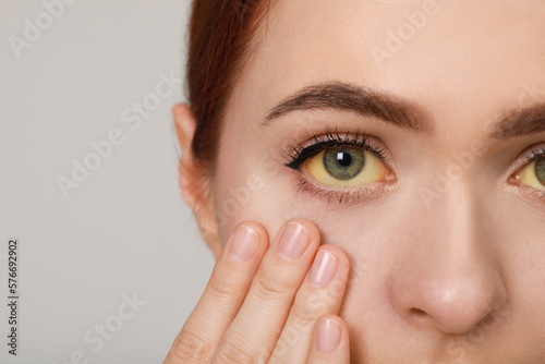 Woman with yellow eyes on light grey background, closeup. Symptom of hepatitis