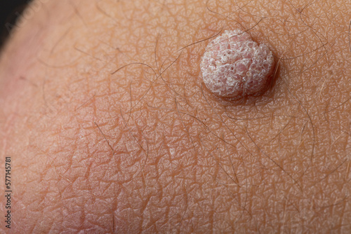 close up of skin, Zoomed-in Shot of Wart on Arm