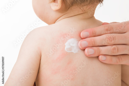 Mother fingers applying white medical ointment on infant bare back isolated on light gray background. Red rash on skin. Allergy from food, milk formula or mother milk. Care about baby body. Closeup.