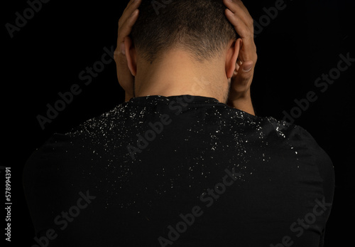 Close up low key portrait of man with dandruff or itchy hair problem. Concept of hair care, dandruff and seborrheic dermatitis.
