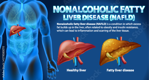 Nonalcoholic Fatty Liver Disease (NAFLD)