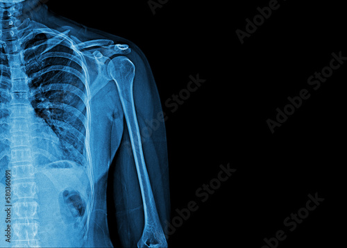 X-ray film of human shoulder