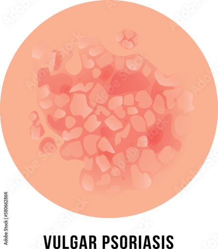 Vulgar psoriasis not pustular type eczema skin disease dermatitis infographic scheme vector flat