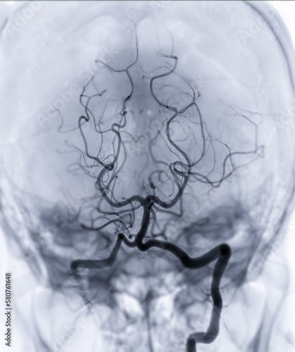 Cerebral angiography imageor potesterior cerebral artery from Fluoroscopy in intervention radiology showing Basilar artery.