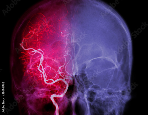Cerebral angiography image from Fluoroscopy in intervention radiology showing cerebral artery.