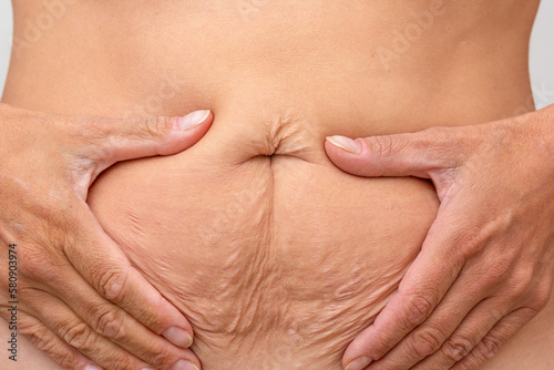 Hands on belly pressed skin to show sagging skin after diet and stretch marks after pregnancy