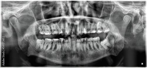 Panoramic Dental X-ray picture - 35 years old male have fourth molar on left side - most of tooths is with a fillings