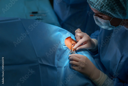 The doctor performs an operation on the eyes. A female surgeon sets up a medical retractor. Ophthalmological clinic