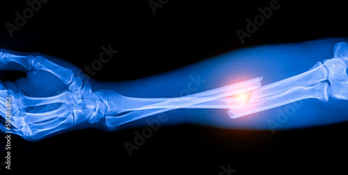 Blue tone radiograph on background in hospital. The doctor used an xray for diagnosis. Forearm fracture in accident patient. X-ray of child or children in orthopedic surgery unit with light effect.