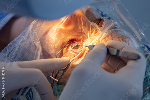 Laser vision correction. A patient and team of surgeons in the operating room during ophthalmic surgery. Patient under sterile lid.Ophthalmology surgery for eyes with laser correction for vision.