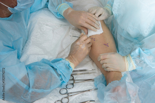 Doctor with assistant in sterile surgical gowns performs operation on patient's leg during operation. Vascular surgeon prepared for incision of marked veins for surgery to remove varicose veins