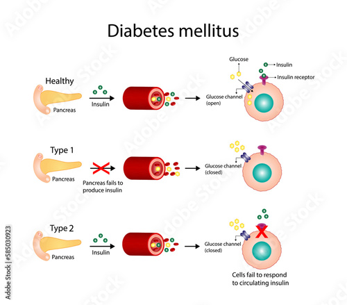 Diabetes mellitus type 1, pancreas's failure to produce enough insulin and type 2, cells fail to respond to insulin (Insulin resistance). Result in high blood glucose levels. Vector illustration
