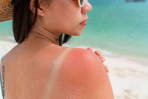 Sunburned skin on shoulder of a woman because of not using cream with sunscreen protection. Red skin sun burn after Sunbathing at the beach. Summer and holiday concept