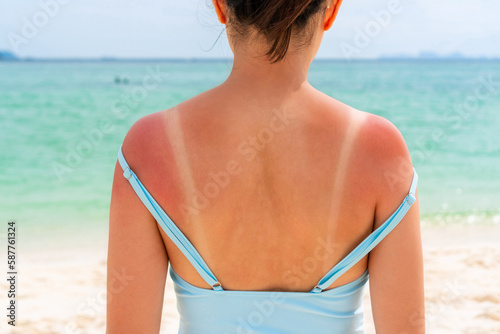 Sunburned skin on shoulder and back of a woman because of not using cream with sunscreen protection. Red skin sun burn after Sunbathing at the beach. Summer and holiday concept. Close up