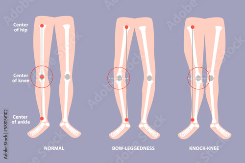 3D Isometric Flat Vector Conceptual Illustration of Valgus Deformity , Cosmetic Pathology