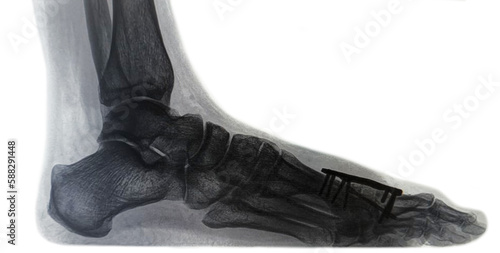 Xray image of Bone block distraction arthrodesis - MTP1 of the hallux metatarsophalangeal joint after resection arthroplasty. female foot after surgery - standing position with minimal load, pressure