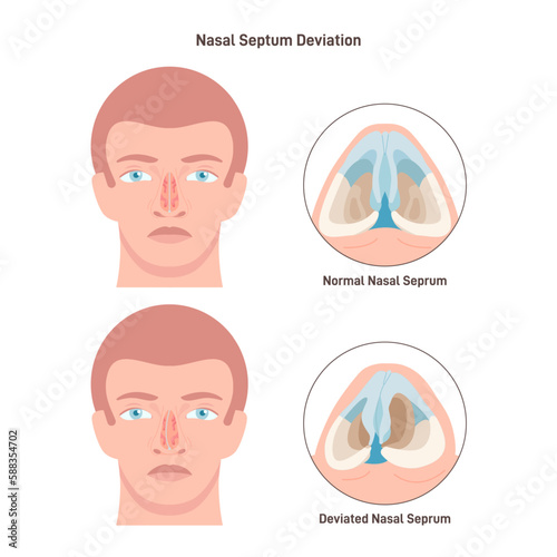 Deviated and normal nasal septum. Medical condition of crooked