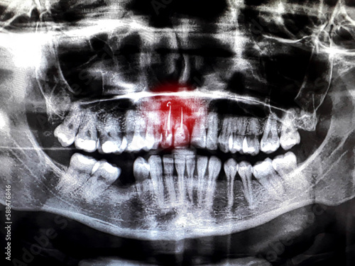 Panoramic dental X-Ray, two root canal treatments with red area