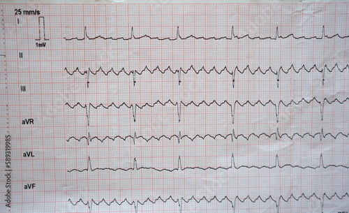 real ecg showing atrial flutter (good to see in serrated waves in II, III and aVF).