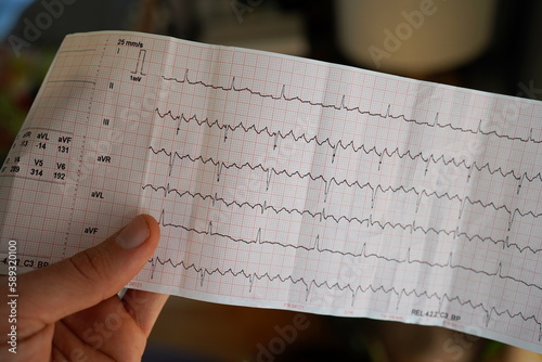 Hand holding a real electrocardiogram with atrial flutter. 